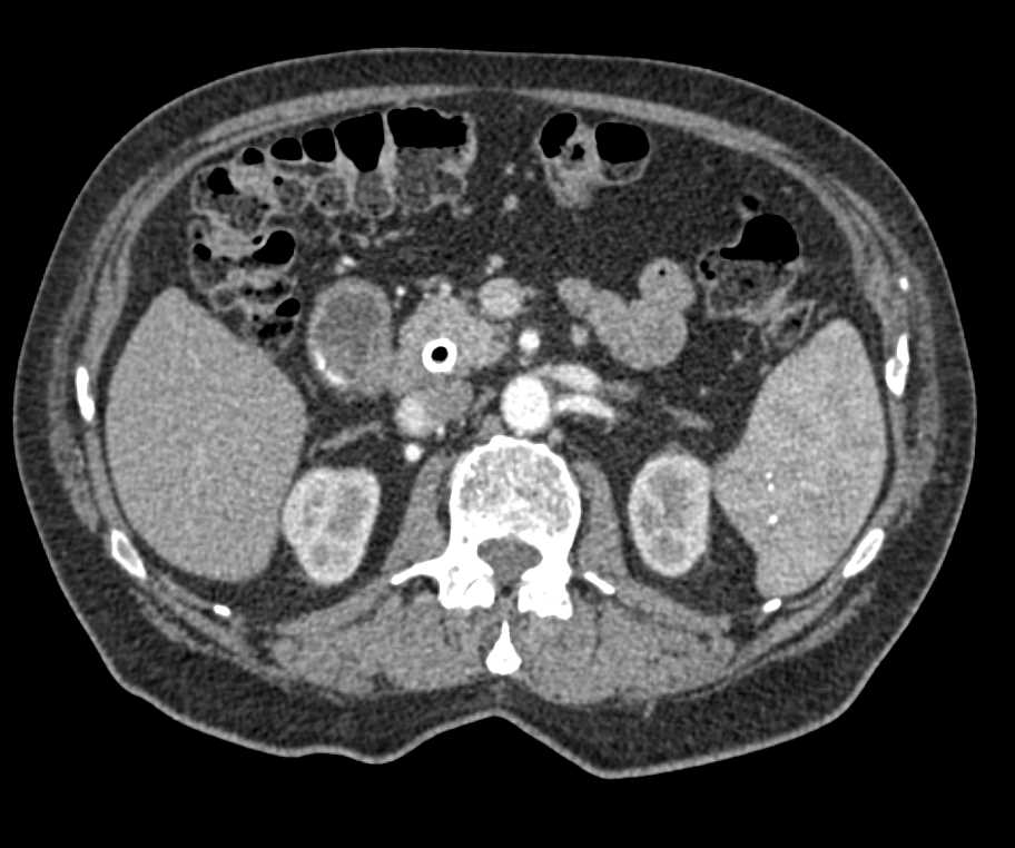 Pancreatic Cancer with Stent in the Common Bile Duct (CBD) - CTisus CT Scan