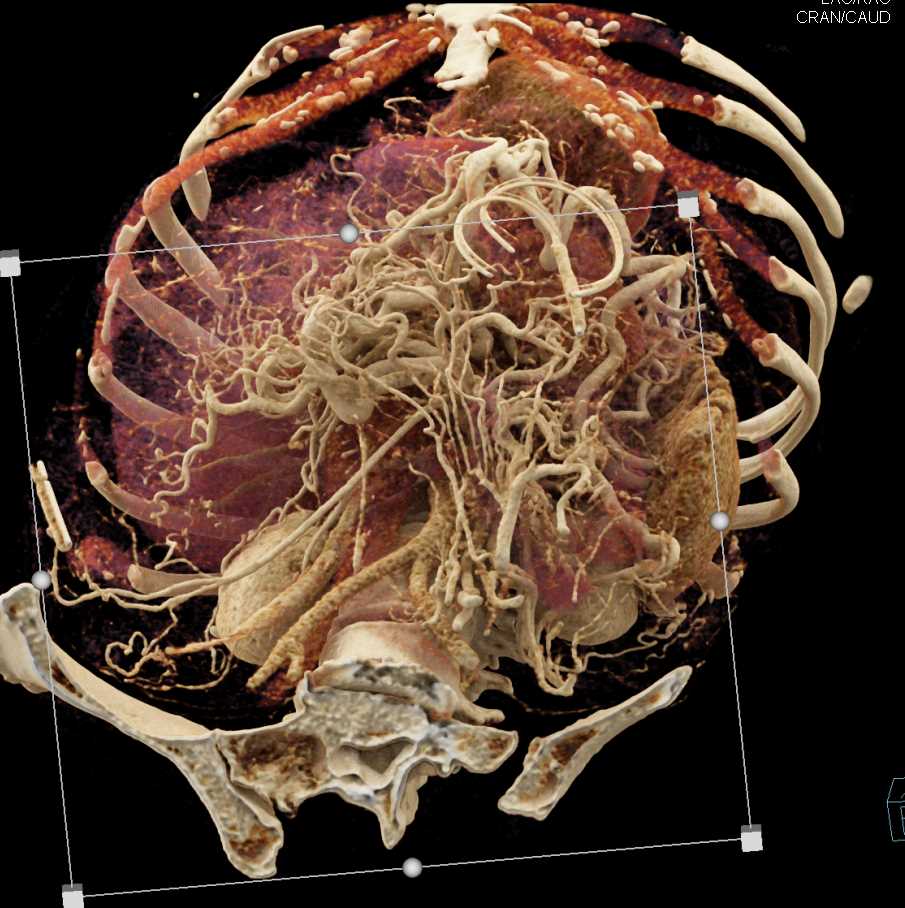 Adenocarcinoma Pancreas with Vascular Invasion - CTisus CT Scan