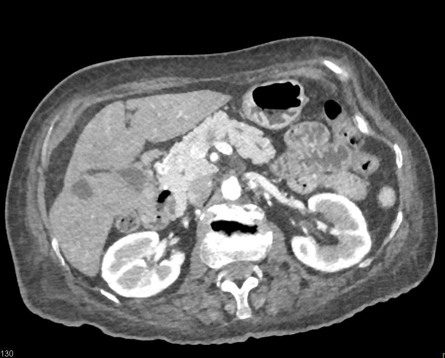 Pancreas Adenocarcinoma - CTisus CT Scan