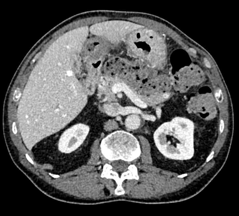 Multiple Neuroendocrine Tumors in the Pancreas - CTisus CT Scan