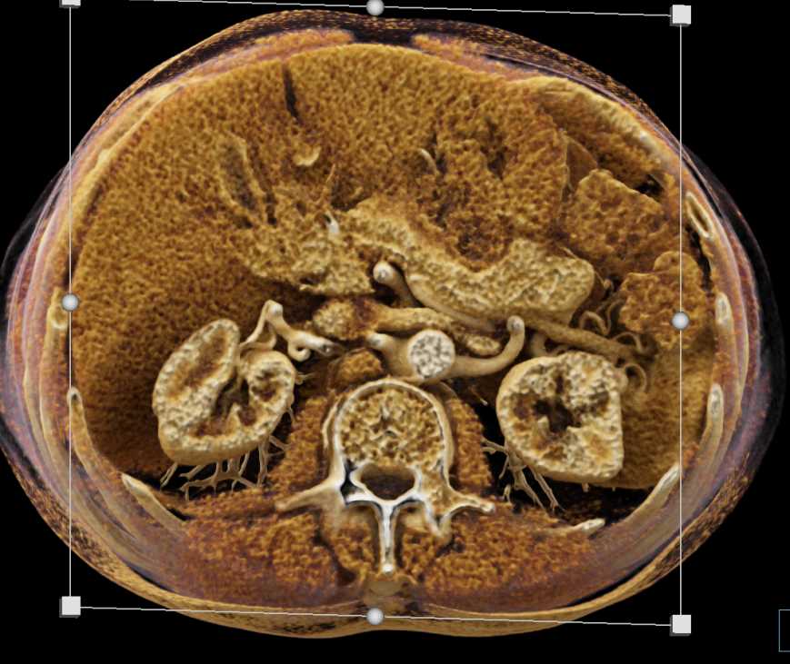 Superior Mesenteric Artery (SMA) and Superior Mesenteric Vein (SMV) Pancreas Margins - CTisus CT Scan