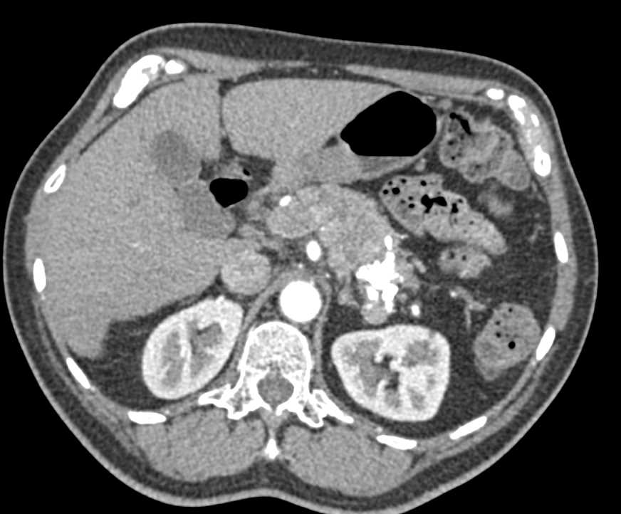 Neuroendocrine Tumor Calcified Tail of Pancreas - CTisus CT Scan