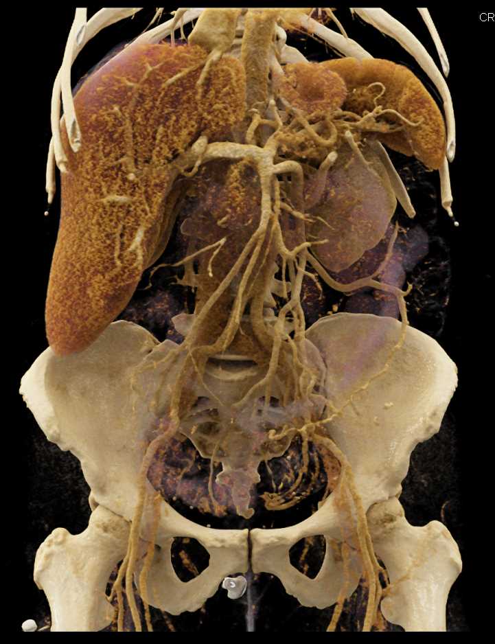 Pancreatic Cancer with Vascular Encasement - CTisus CT Scan