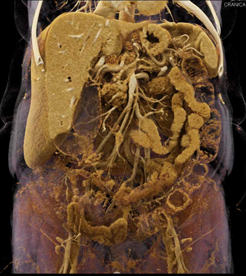 Pancreatic Cancer with Vascular Encasement - CTisus CT Scan