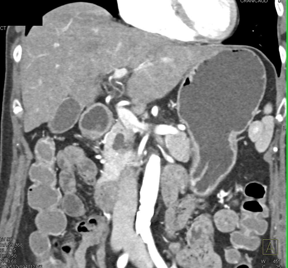 Intraductal Papillary Mucinous Neoplasm (IPMN) - CTisus CT Scan