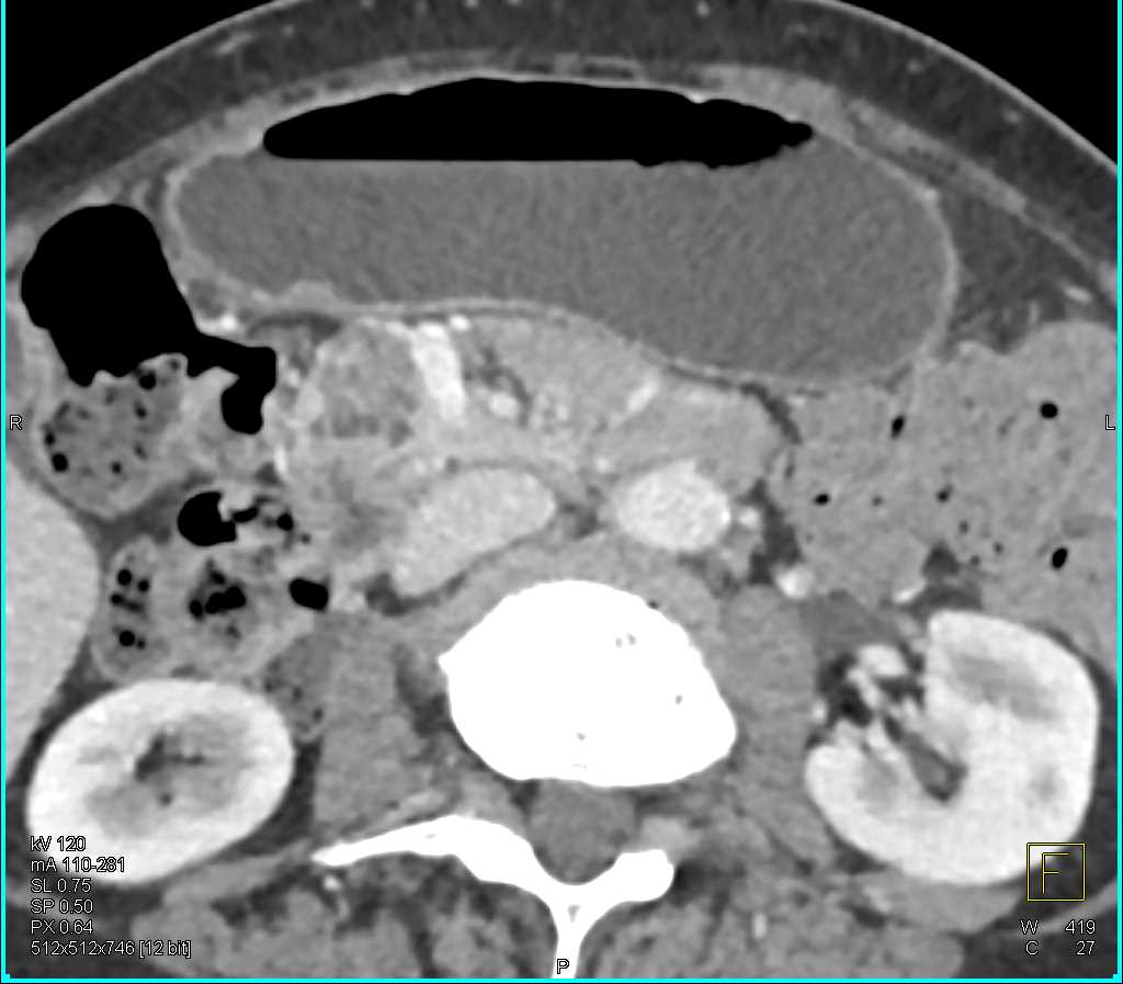 Serous Cystadenoma in Head of Pancreas - CTisus CT Scan