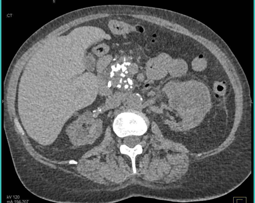 End Stage Renal Disease and Chronic Pancreatitis - CTisus CT Scan