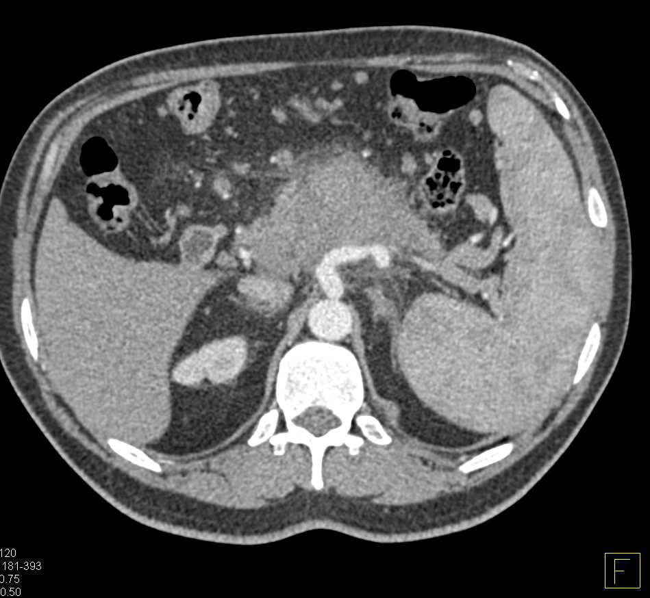 Acute Pancreatitis Simulates a Tumor - CTisus CT Scan