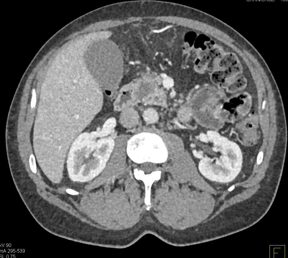 Pancreas Adenocarcinoma with Pancreatic Duct Cutoff - CTisus CT Scan