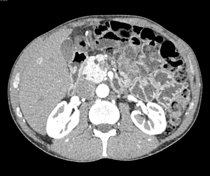 Neuroendocrine Tumor of the Pancreas - CTisus CT Scan