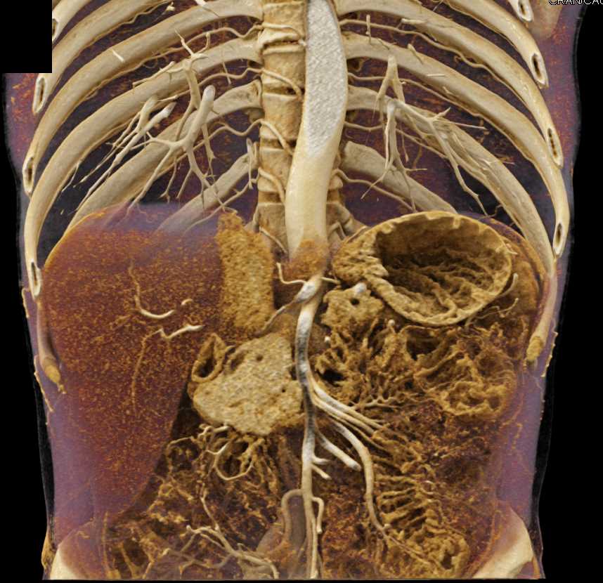 Neuroendocrine Tumor of the Pancreas - CTisus CT Scan