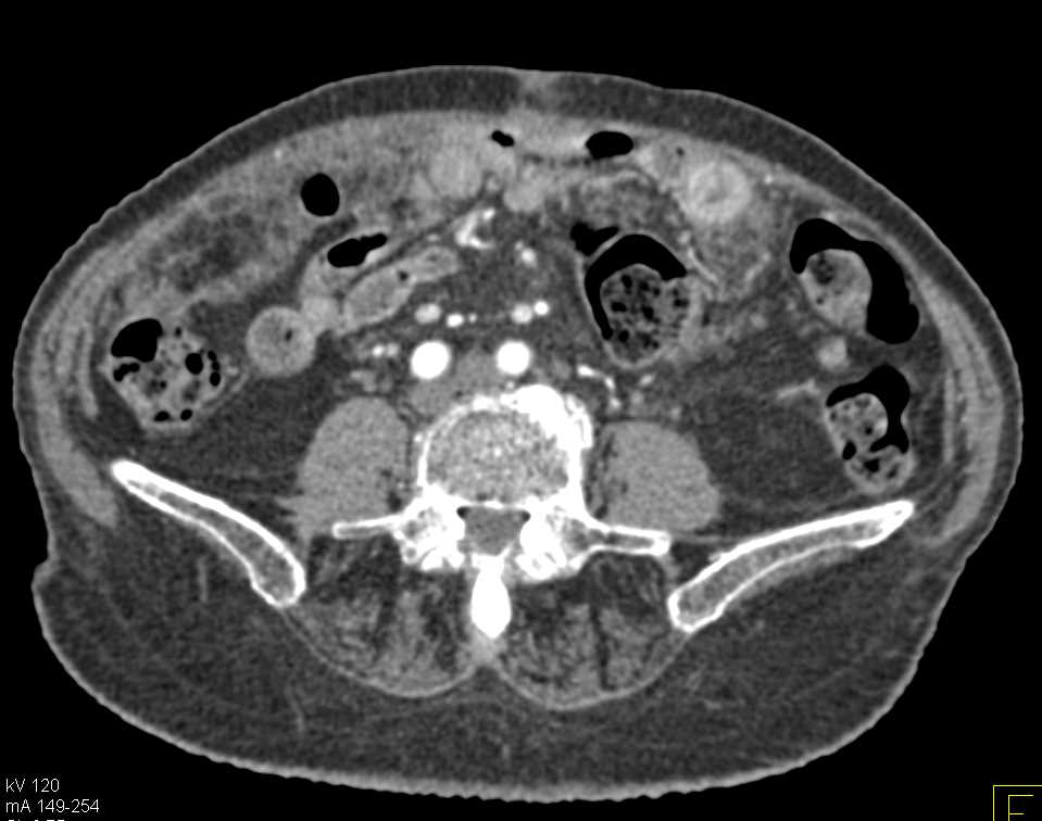 Carcinomatosis from Pancreatic Adenocarcinoma - CTisus CT Scan