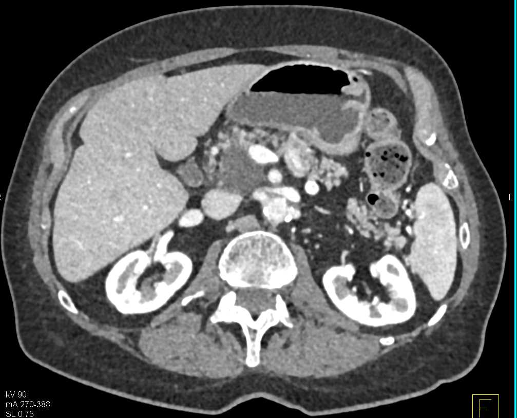 Intraductal Papillary Mucinous Neoplasm (IPMN) Head of Pancreas - CTisus CT Scan