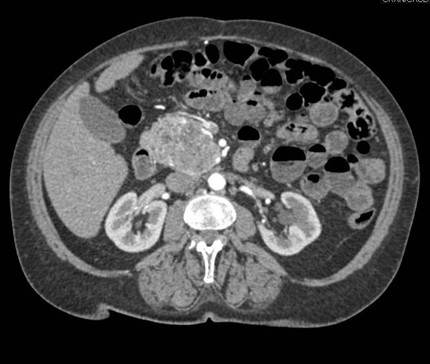 Neuroendocrine Tumor Pancreas - CTisus CT Scan