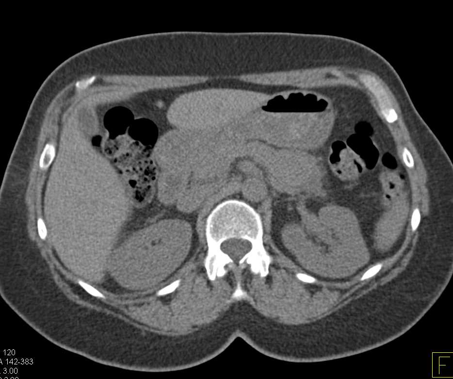 Unusual Appearance of Solid and Papillary Epithelial Neoplasm (SPEN) Tumor Pancreas - CTisus CT Scan