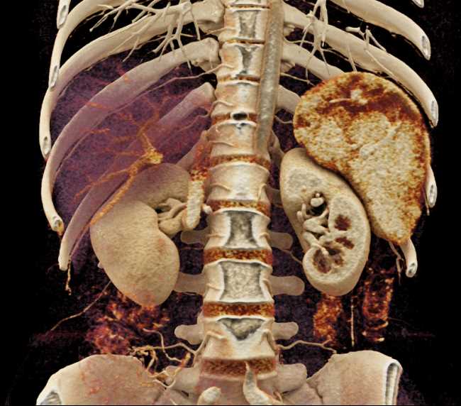 Dilated Pancreatic Duct Seen on Cinematic Rendering - CTisus CT Scan