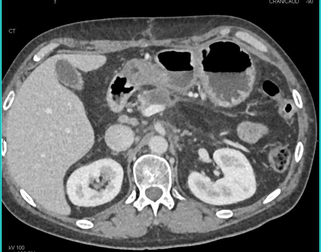 Adenocarcinoma Panreas - CTisus CT Scan