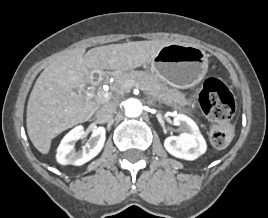 Autoimmune Pancreatitis - CTisus CT Scan