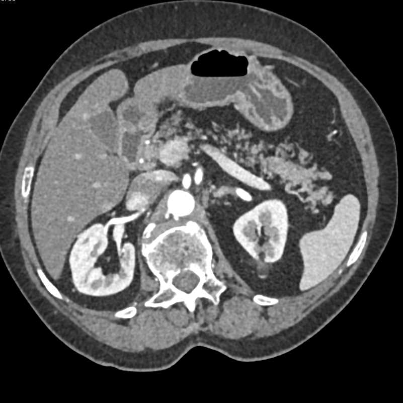 Neuroendocrine Tumor in the Head of the Pancreas - CTisus CT Scan