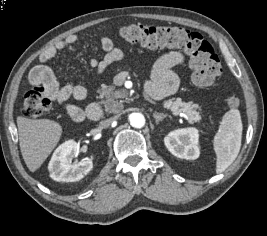 Intraductal Papillary Mucinous Neoplasm (IPMN) with Dysplasia in Head of Pancreas - CTisus CT Scan