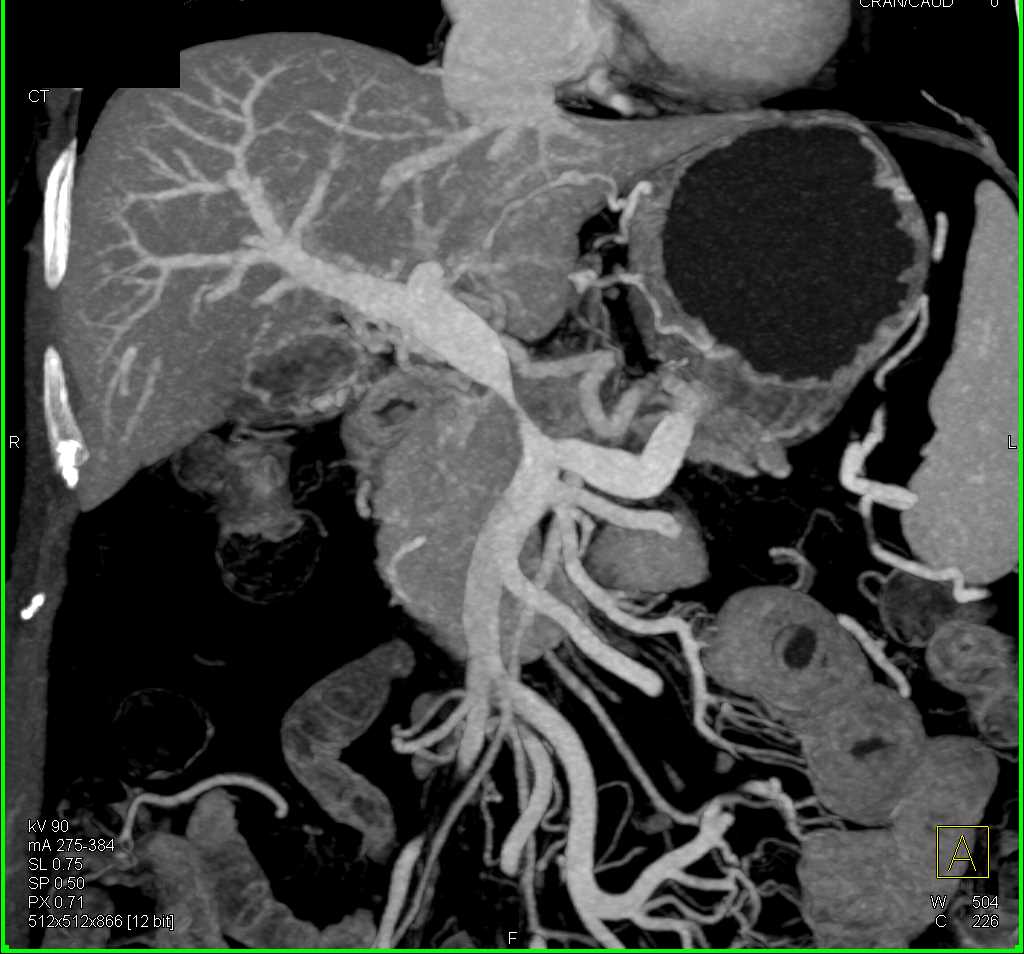 Pancreatic Cancer with Vascular Encasement of Portal Vein/SMV Confluence - CTisus CT Scan