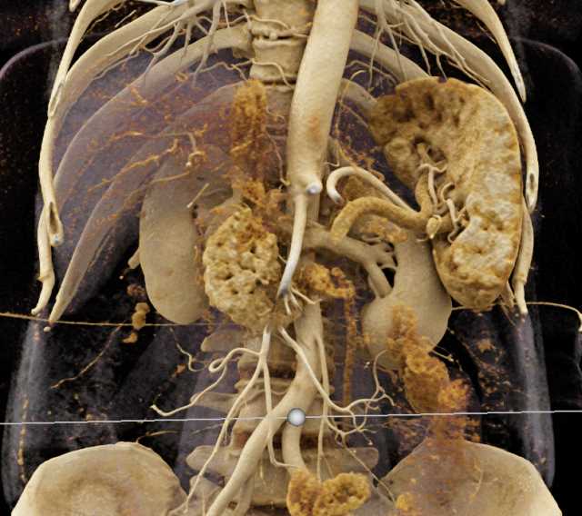 Pancreatic Cancer with Vascular Encasement of Portal Vein/SMV Confluence - CTisus CT Scan