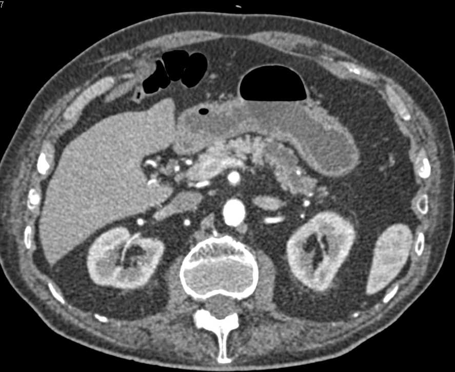 Intraductal Papillary Mucinous Neoplasm (IPMN) with High Grade Dysplasia - CTisus CT Scan