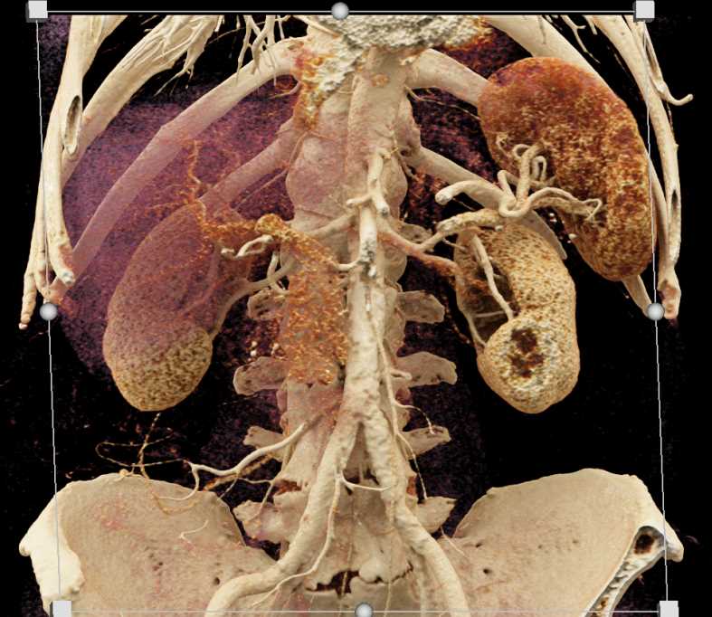 Intraductal Papillary Mucinous Neoplasm (IPMN) with High Grade Dysplasia - CTisus CT Scan