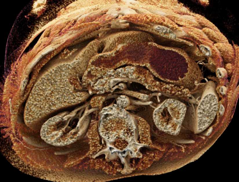 Intraductal Papillary Mucinous Neoplasm (IPMN) with High Grade Dysplasia - CTisus CT Scan