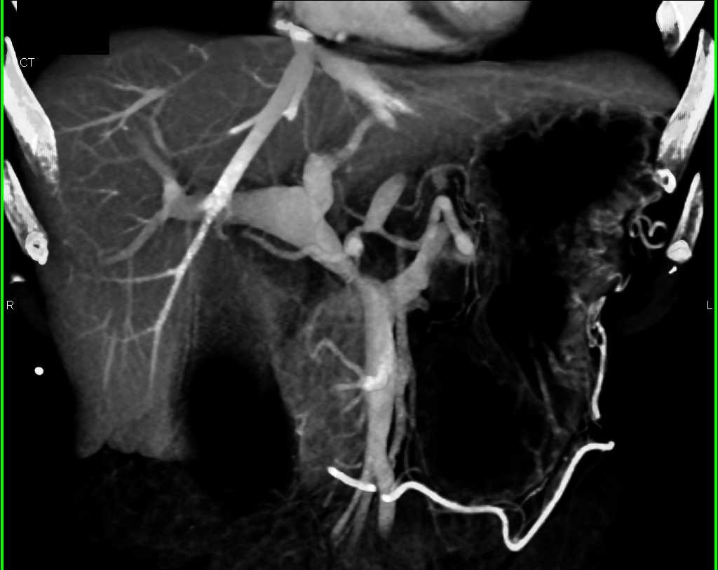 Pancreatic Cancer with Vascular Invasion - CTisus CT Scan