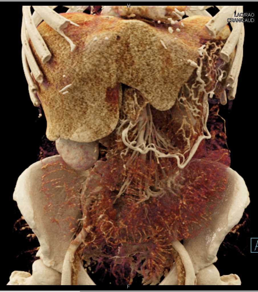 Pancreatic Cancer with Vascular Invasion and Thickening of Small Bowel - CTisus CT Scan