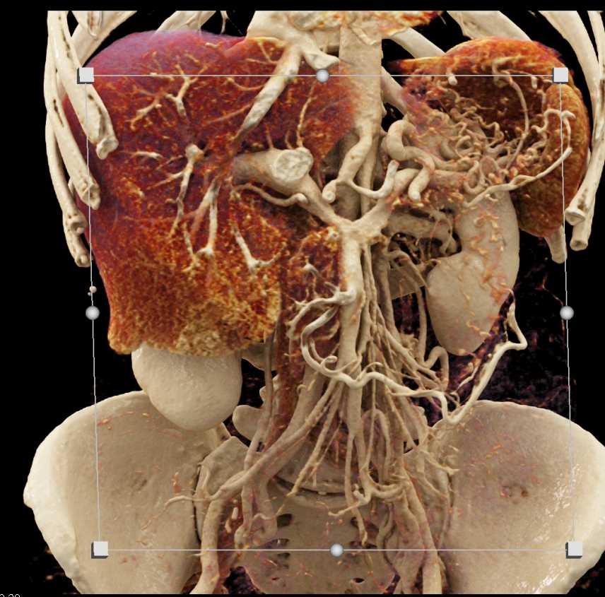 Pancreatic Cancer with Vascular Invasion - CTisus CT Scan