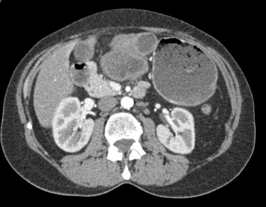 Omental Infarct Near Surgical Bed Simulates a Recurrent Tumor - CTisus CT Scan