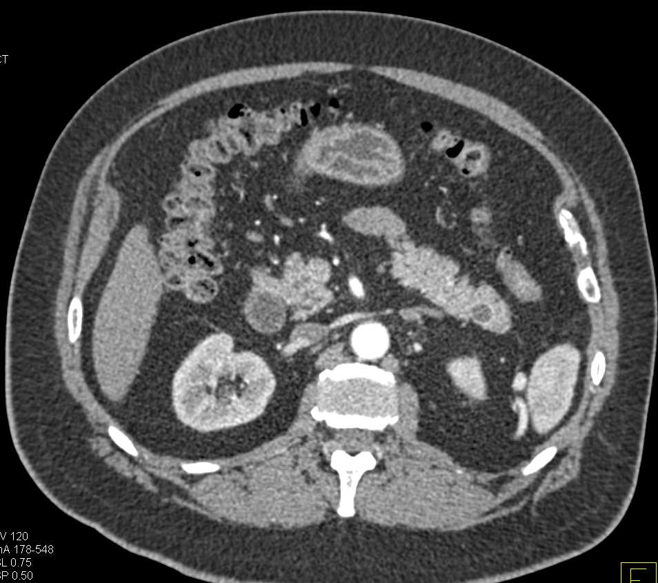 Cystic Neuroendocrine Tumor Tail of the Pancreas - CTisus CT Scan