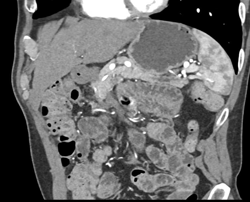 Stent in Pancreatic Duct - CTisus CT Scan