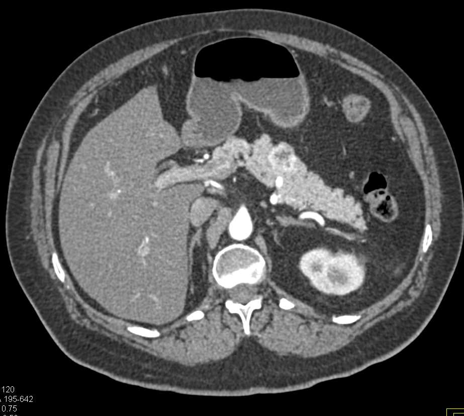 Metastatic Renal Cell Carcinoma to the Pancreas - CTisus CT Scan