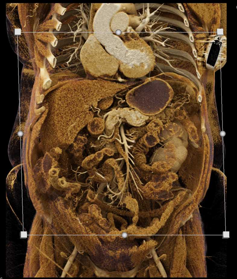 Carcinoma of the Pancreas - CTisus CT Scan