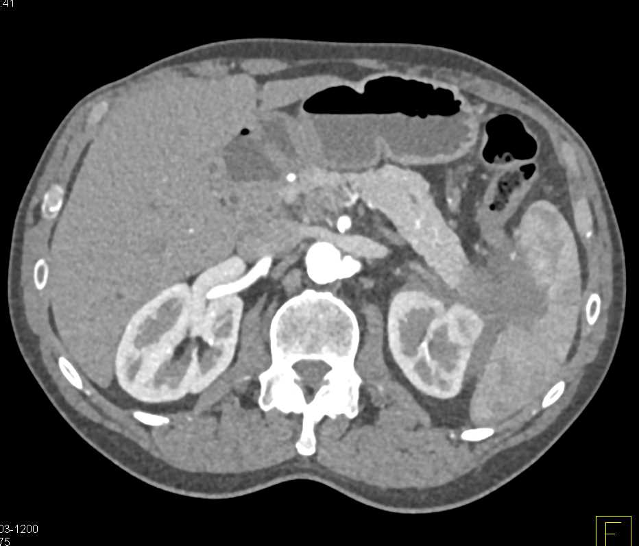 Carcinoma Tail of Pancreas Extends Into the Splenic Hilum - CTisus CT Scan