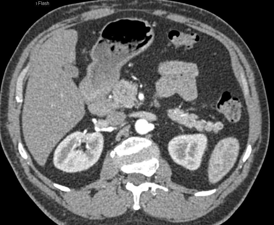 Accessory Spleen Near the Tail of the Pancreas - CTisus CT Scan