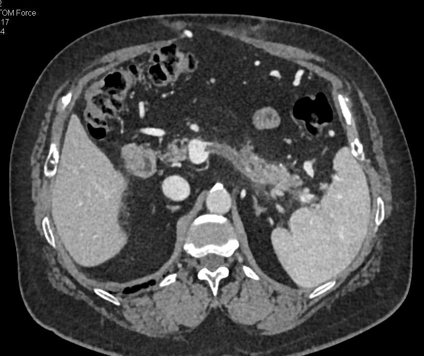 Neuroendocrine Tumor Pancreas with Incidental Pulmonary Emboli (PEs) - CTisus CT Scan