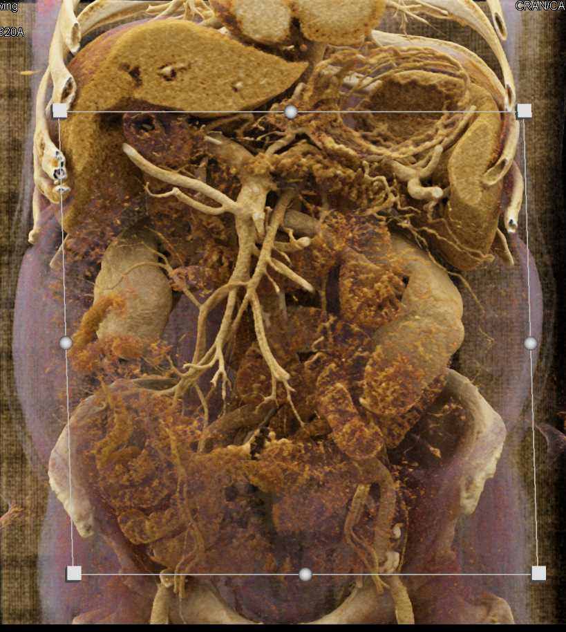 Carcinoma of the Pancreas - CTisus CT Scan