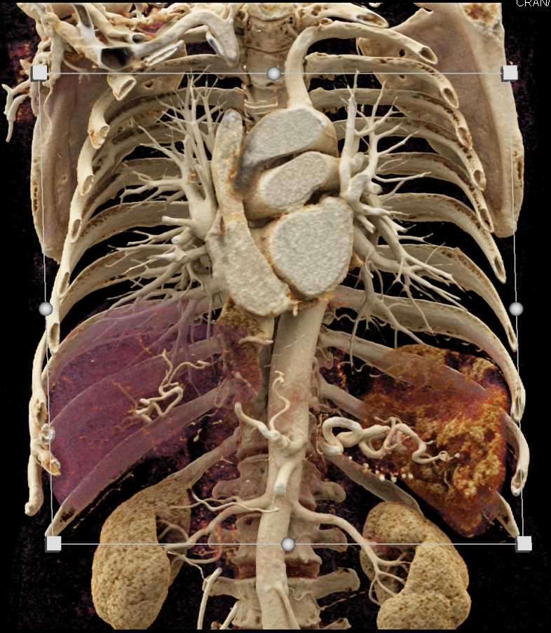 Carcinoma of the Pancreas - CTisus CT Scan