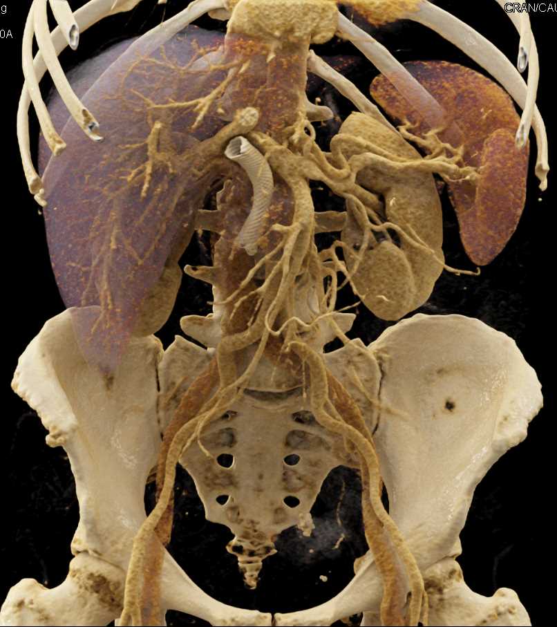 Pancreatic Cancer with Stent in the Common Bile Duct - CTisus CT Scan