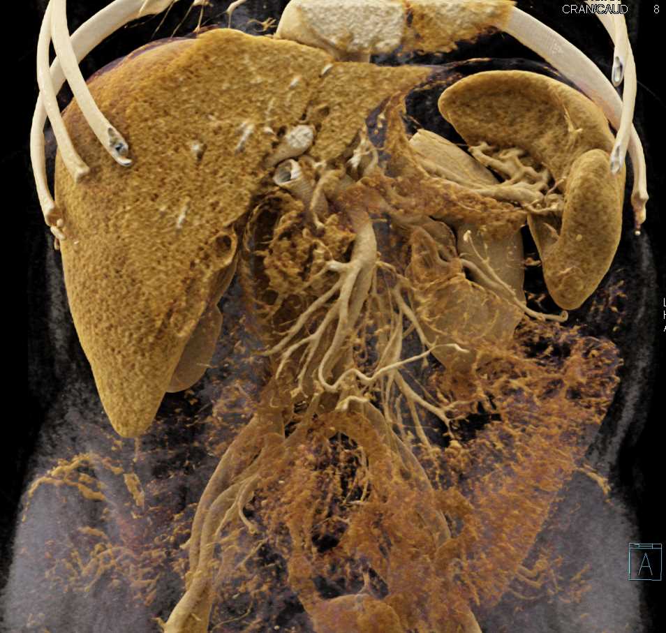 Pancreatic Cancer with Stent in the Common Bile Duct - CTisus CT Scan