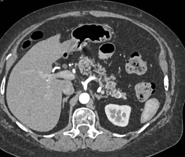 1cm Neuroendocrine Tumor of the Tail of the Pancreas - CTisus CT Scan