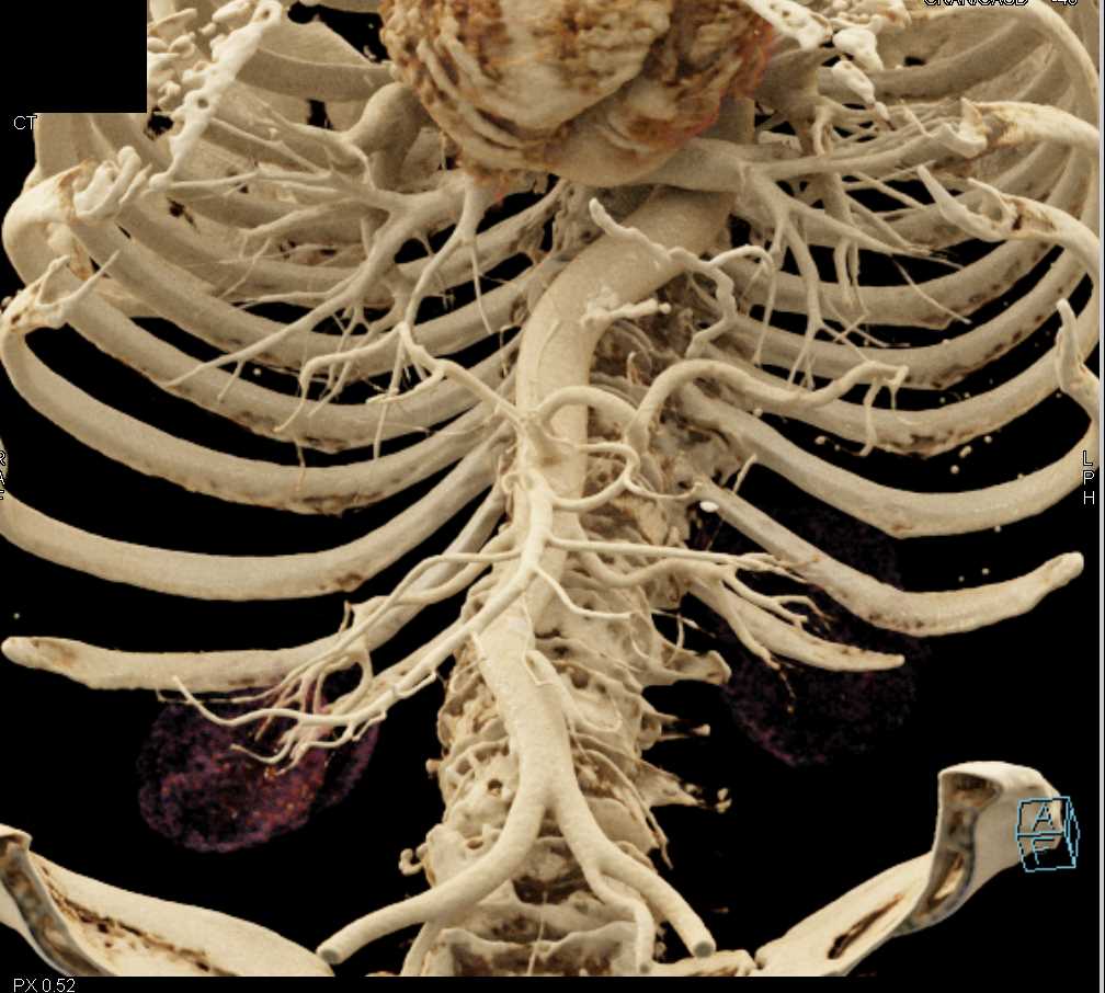 1cm Neuroendocrine Tumor of the Tail of the Pancreas - CTisus CT Scan