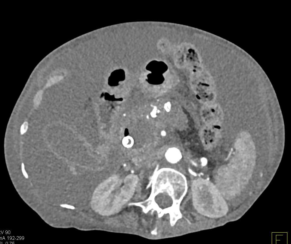 Pancreatic Cancer in a Patient with Chronic Pancreatitis - CTisus CT Scan