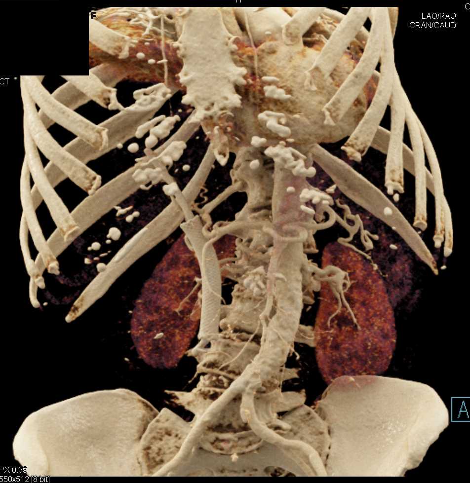 Pancreatic Cancer with Stent and Ascites - CTisus CT Scan