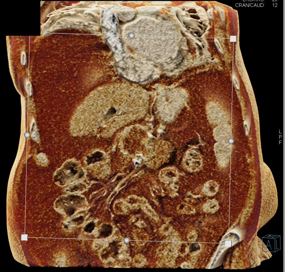 Pancreatic Cancer with Ascites with Cinematic Rendering - CTisus CT Scan