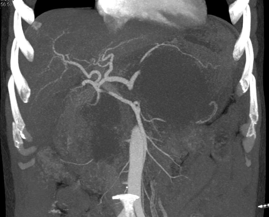 Pseudocyst S/P Pancreatitis - CTisus CT Scan